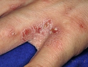 Scabies pdf spanish lessons